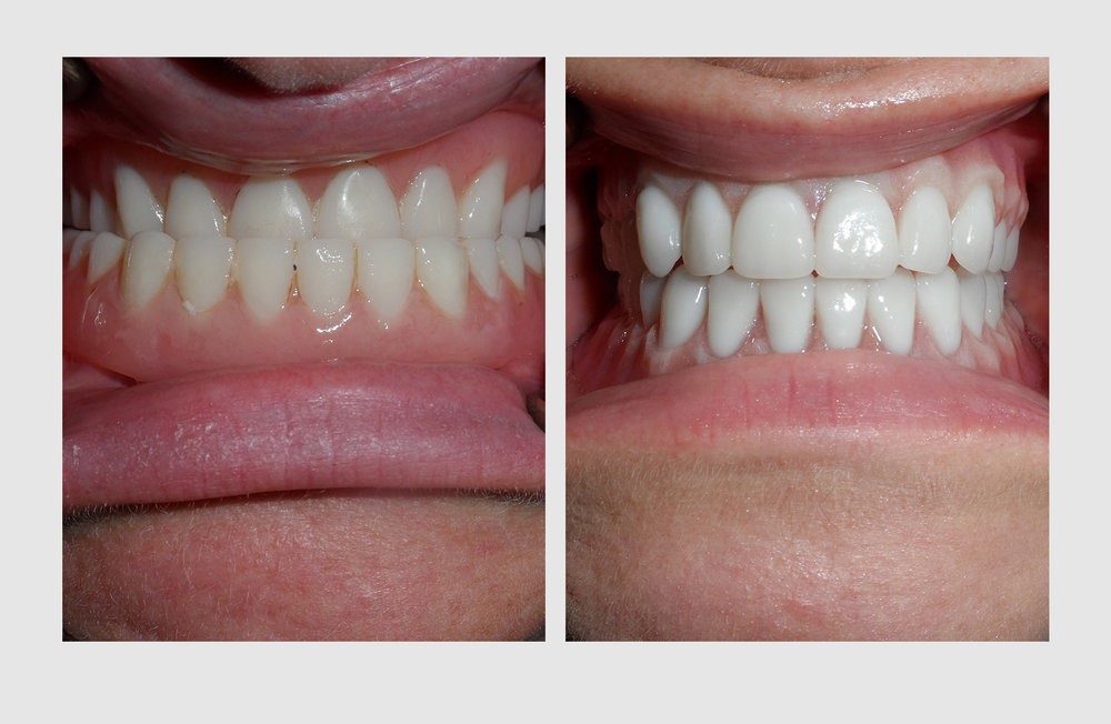 Teeth Dentures Carlisle NY 12031